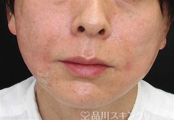 症例NO.58100のAFTER写真