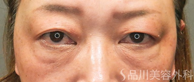 症例NO.69997のBEFORE写真