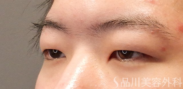 症例NO.72454のBEFORE写真