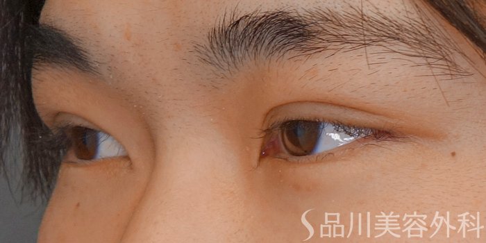 症例NO.70328のAFTER写真