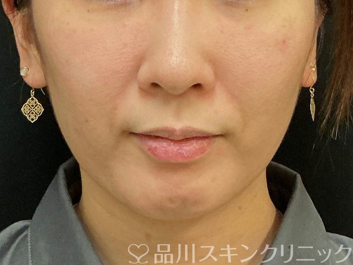 症例NO.74034のBEFORE写真