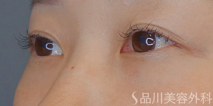 症例NO.71737のBEFORE写真