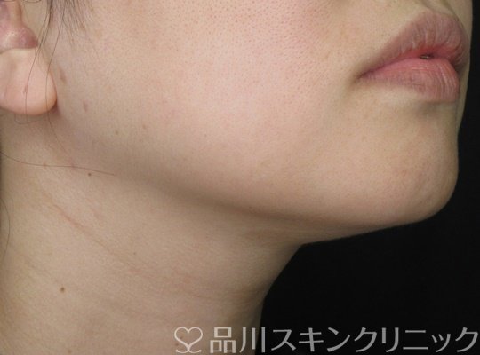 症例NO.70169のAFTER写真