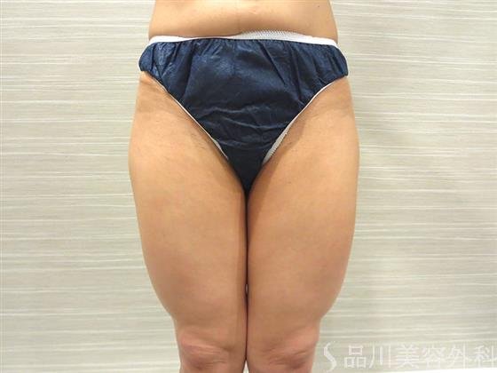 症例NO.20559のBEFORE写真