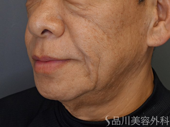 症例NO.74799のBEFORE写真