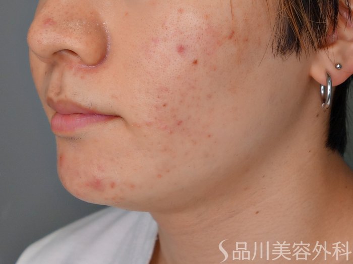 症例NO.69212のBEFORE写真