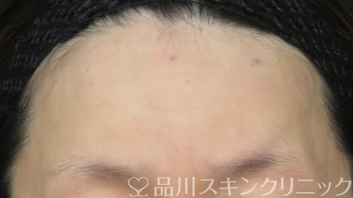 症例NO.71901のAFTER写真