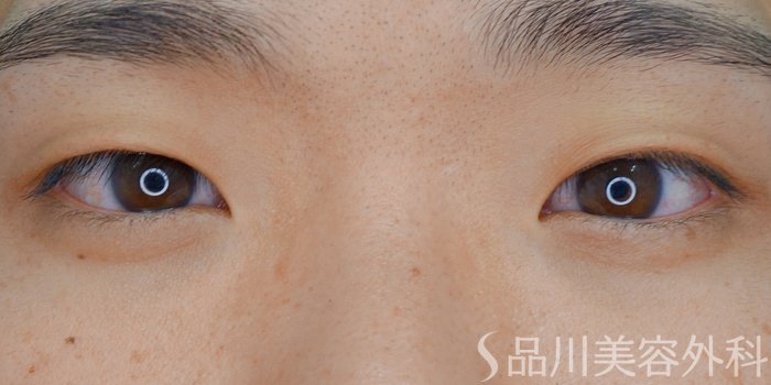 症例NO.70414のBEFORE写真