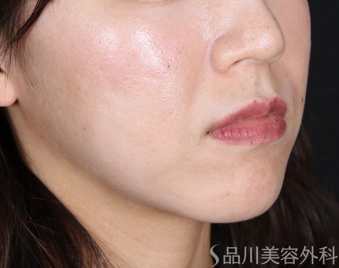 症例NO.72086のAFTER写真