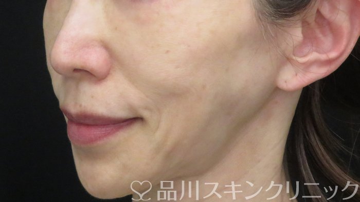 症例NO.71026のBEFORE写真