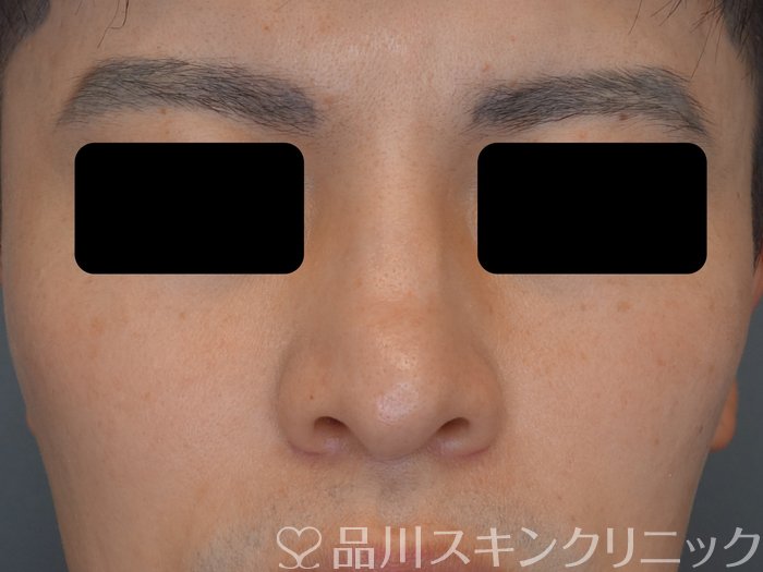 症例NO.74675のBEFORE写真