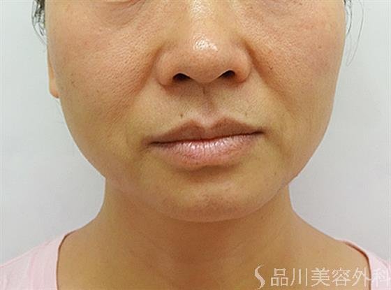 症例NO.44613のBEFORE写真