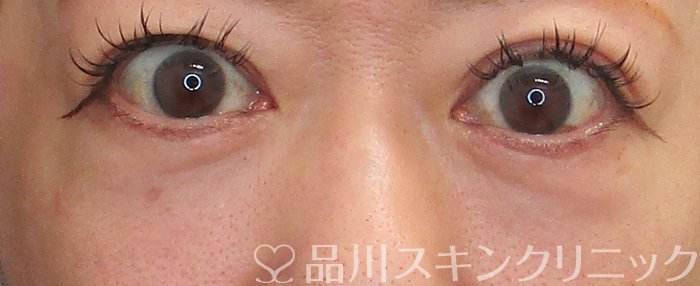 症例NO.72640のAFTER写真