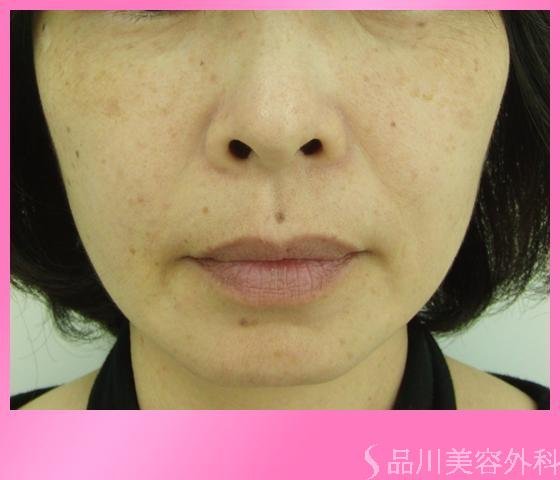 症例NO.4053のBEFORE写真
