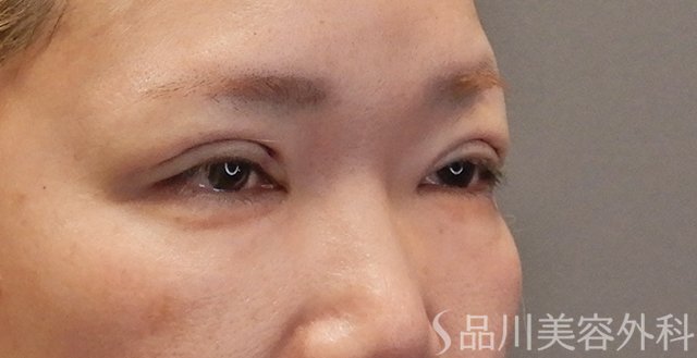症例NO.74771のAFTER写真