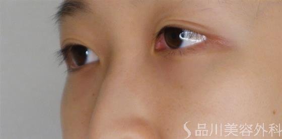 症例NO.52986のBEFORE写真