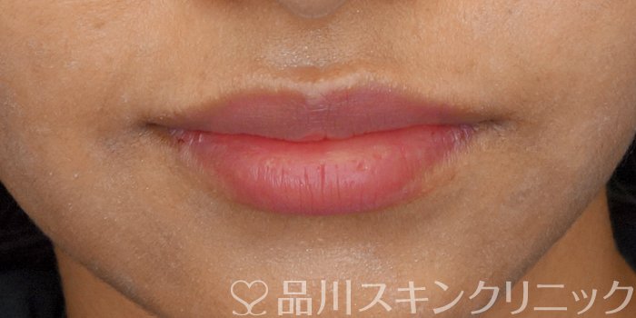 症例NO.72221のAFTER写真