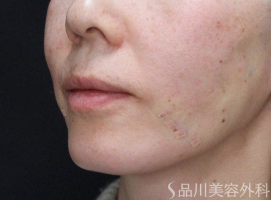 症例NO.72469のAFTER写真