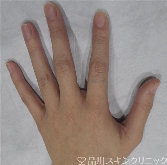 症例NO.33966のBEFORE写真