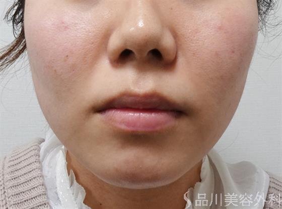 症例NO.51262のBEFORE写真