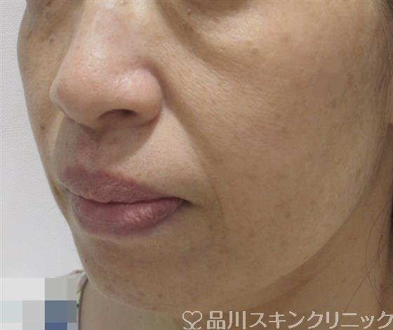 症例NO.38247のBEFORE写真