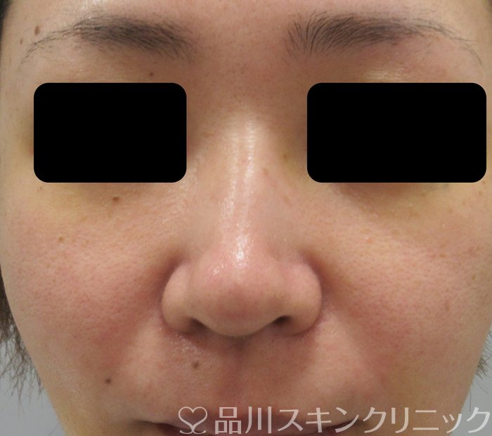 症例NO.74117のAFTER写真