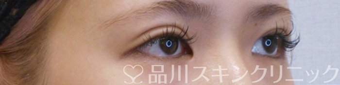 症例NO.75163のAFTER写真