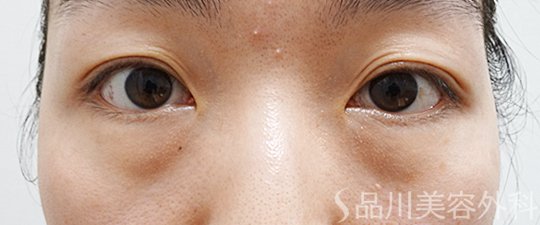 症例NO.69882のBEFORE写真
