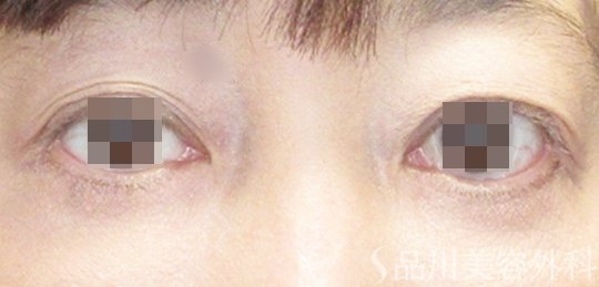 症例NO.71003のAFTER写真
