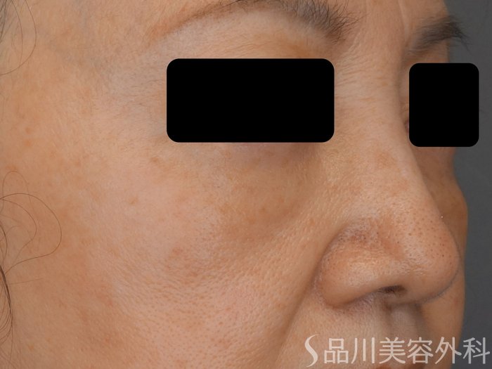 症例NO.73964のAFTER写真
