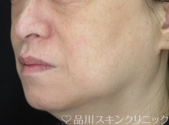 症例NO.69311のBEFORE写真