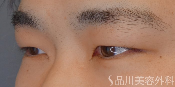 症例NO.70328のBEFORE写真