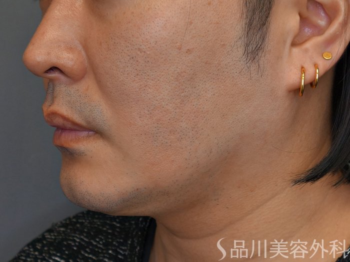 症例NO.73963のBEFORE写真
