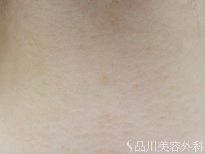 症例NO.72801のAFTER写真