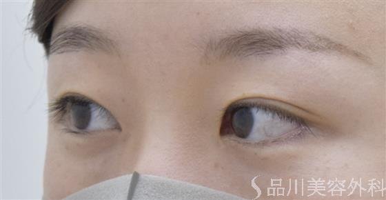 症例NO.51782のBEFORE写真