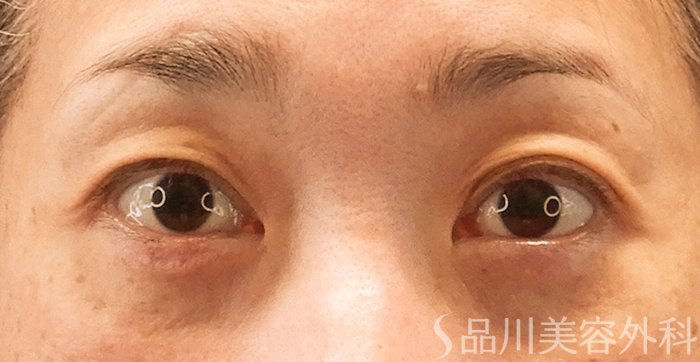 症例NO.70565のAFTER写真