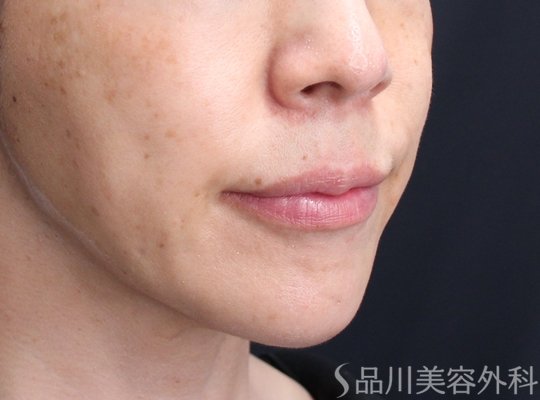 症例NO.72377のAFTER写真