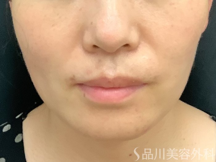 症例NO.67655のBEFORE写真