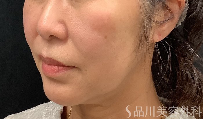 症例NO.67964のBEFORE写真