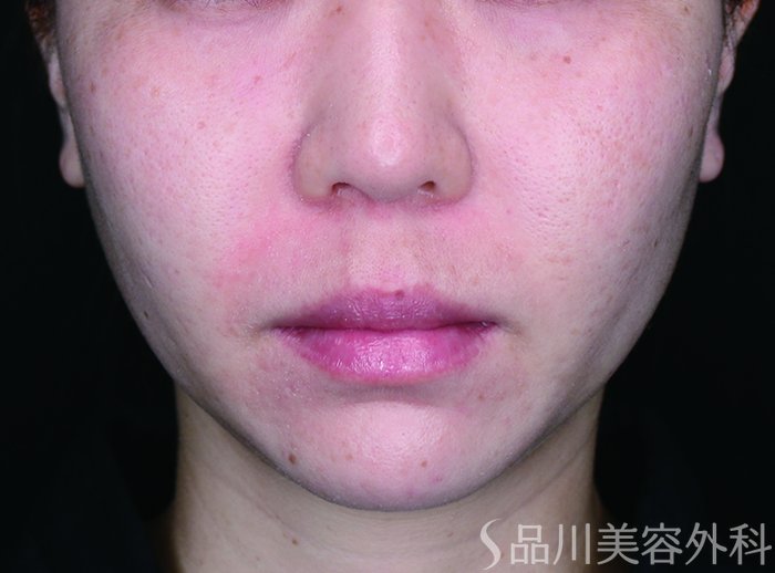 症例NO.72919のAFTER写真