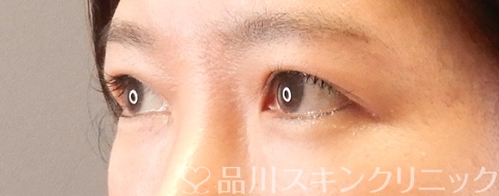 症例NO.63407のAFTER写真