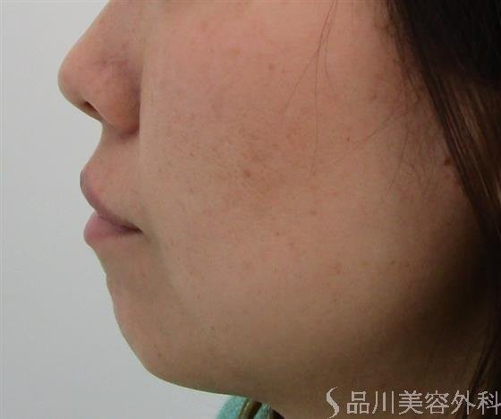 症例NO.43081のBEFORE写真