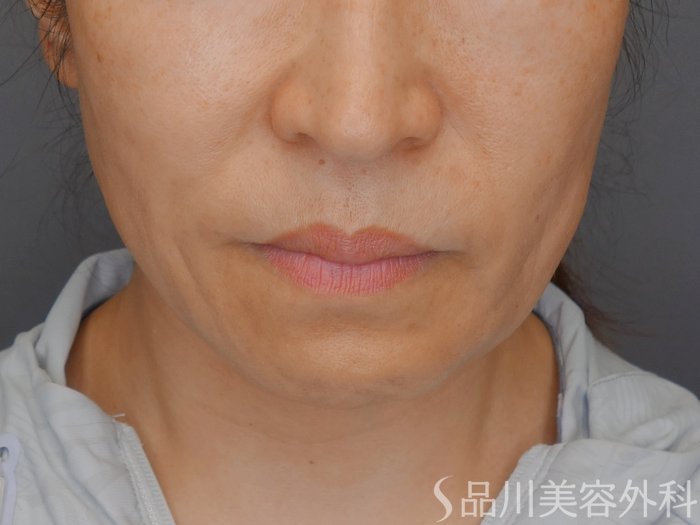 症例NO.71087のBEFORE写真