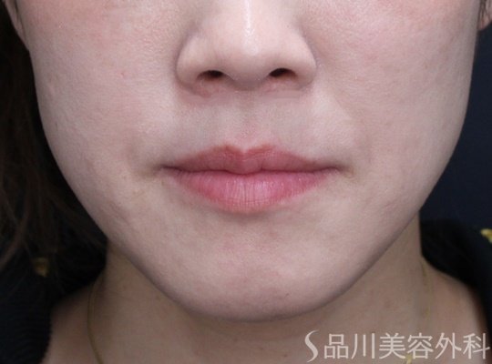 症例NO.69603のAFTER写真