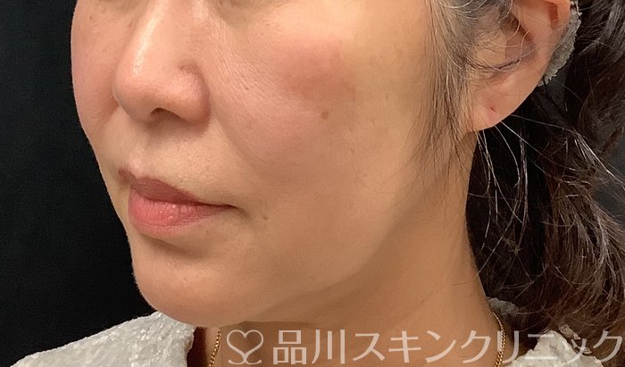 症例NO.67964のBEFORE写真