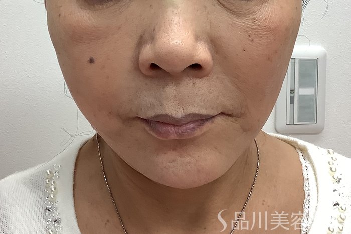 症例NO.62155のAFTER写真