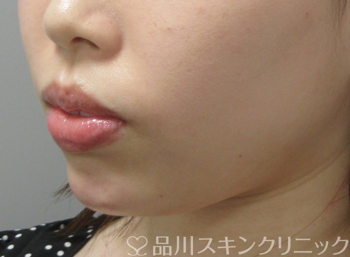 症例NO.70805のAFTER写真
