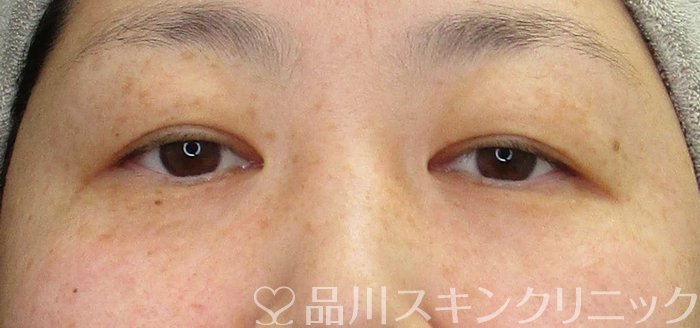 症例NO.69723のBEFORE写真