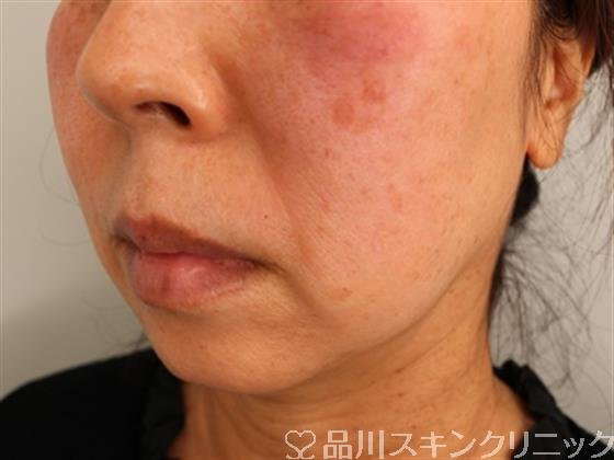 症例NO.50290のBEFORE写真