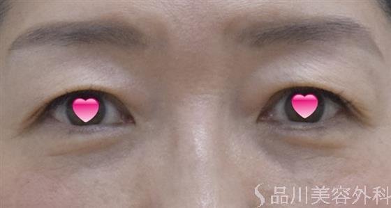 症例NO.52440のAFTER写真